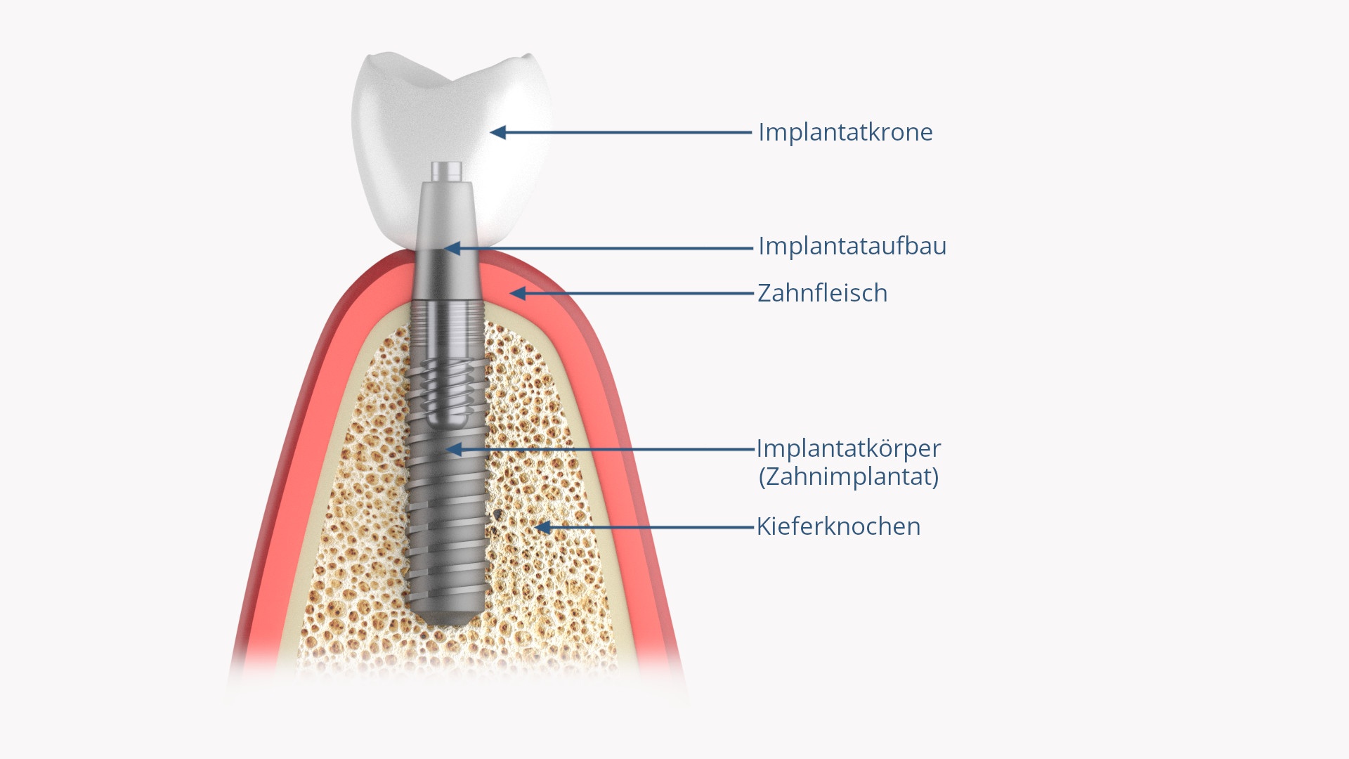 Aufbau eines Zahnimplantates mit Krone und Abutment